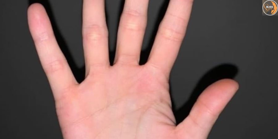 Nốt ruồi son trong lòng bàn tay phải của nữ giới