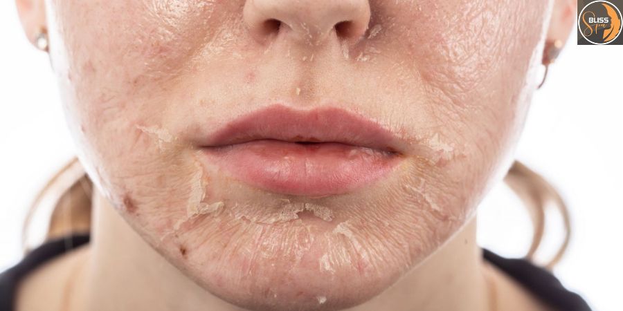 ưu nhược điểm peel da